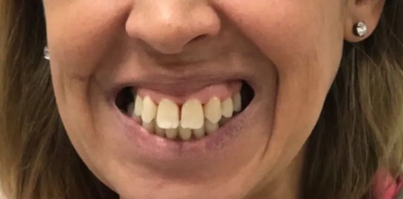Antes: sonrisa que muestra mucha encía.