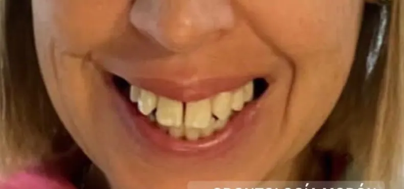 Después: la misma sonrisa, con menos encía a la vista.
