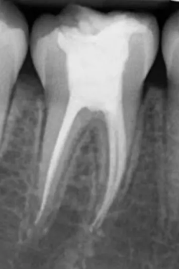Radiografía de un diente con tratamiento de conducto.