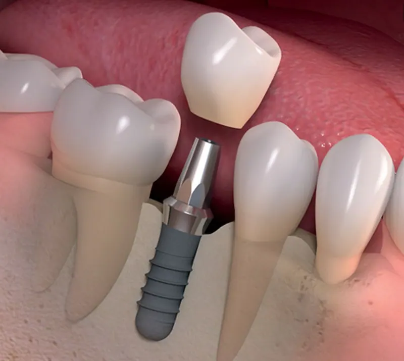 Ilustración de un implante dental con su corona.
