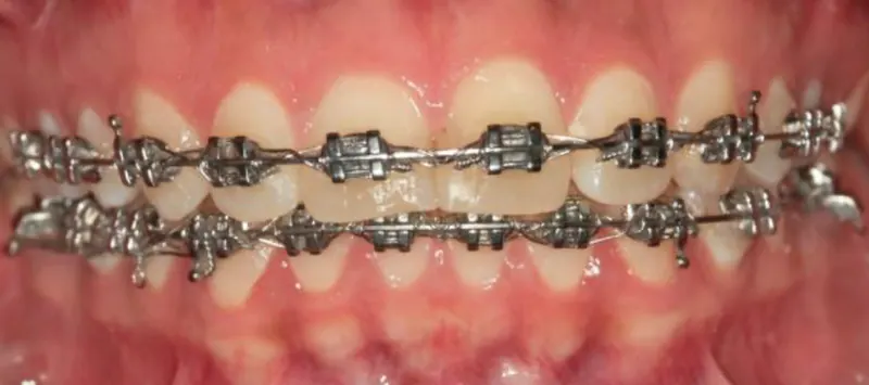 Dientes con brackets.